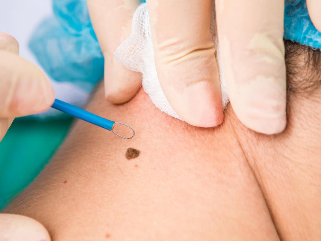 Mole Removal