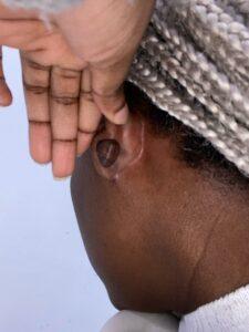 Earlobe keloid removal before and after Birmingham