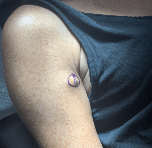 Cyst on the arm marked before removal