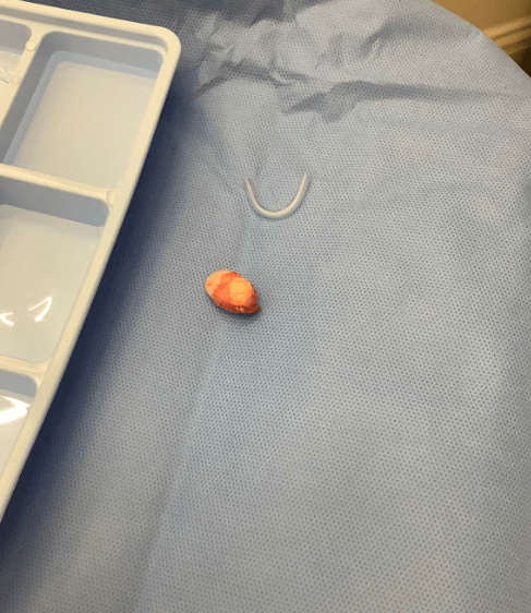 Arm cyst sac removed intact