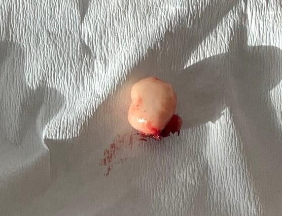 Cyst sac excised intact
