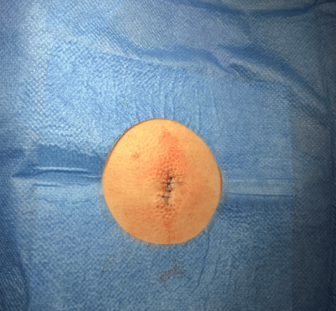 Cyst on the back after removal
