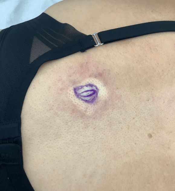Cyst on the back marked before removal