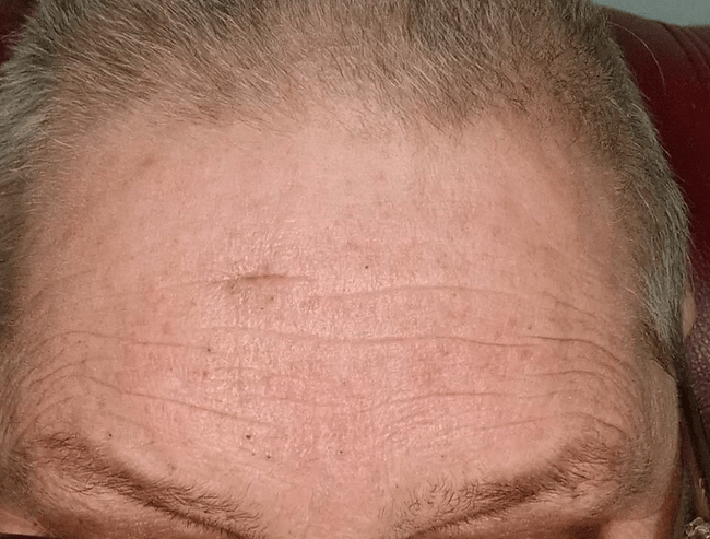 Forehead three weeks after cyst removal