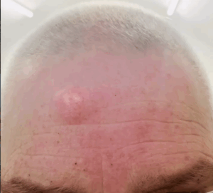 sebaceous cyst excision Birmingham