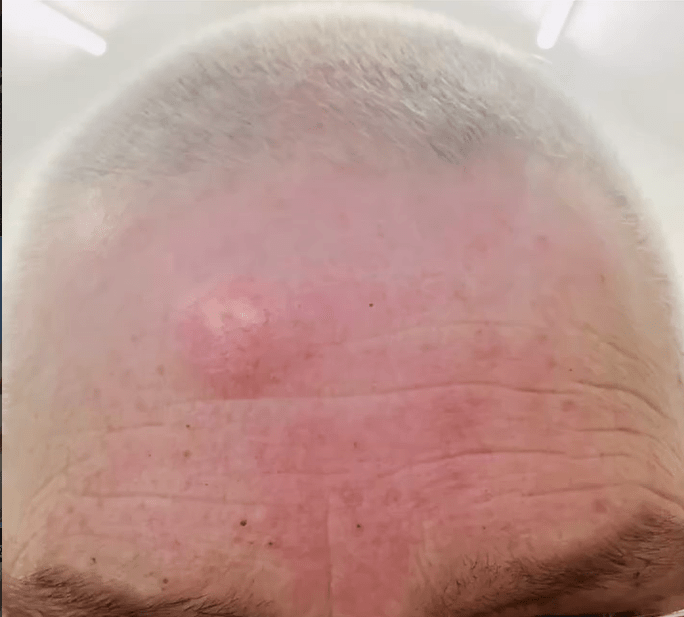 Forehead cyst before removal