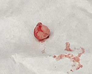 sebaceous cyst excision Birmingham