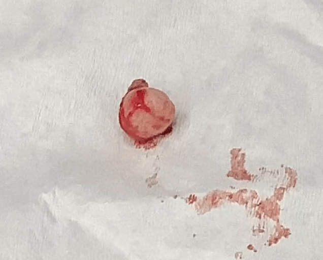Forehead cyst sac removed intact
