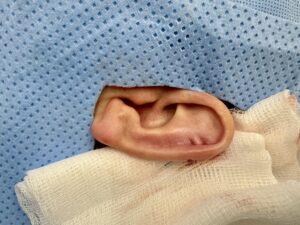 Earlobe keloid removal before and after Birmingham