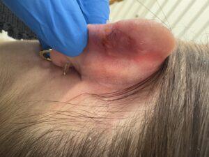Earlobe keloid removal before and after Birmingham