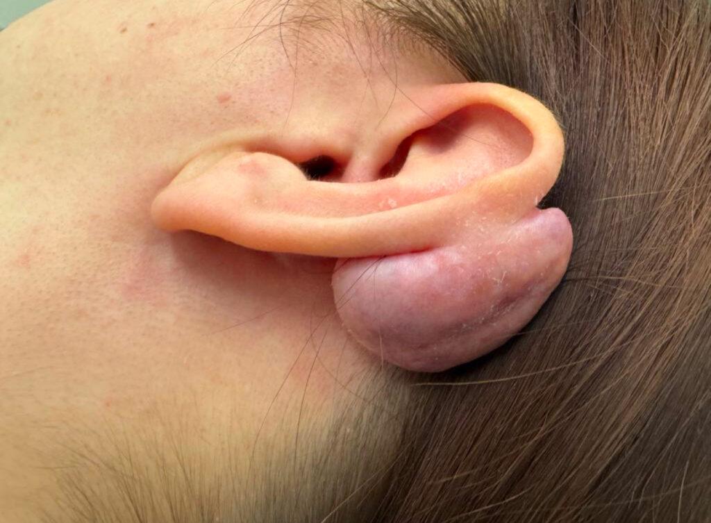 Before ear keloid removal Birmingham