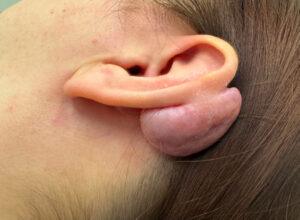 Before ear keloid removal Birmingham