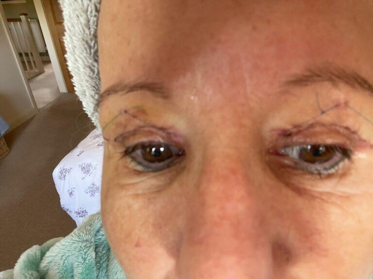 Upper blepharoplasty with stitches in day 5
