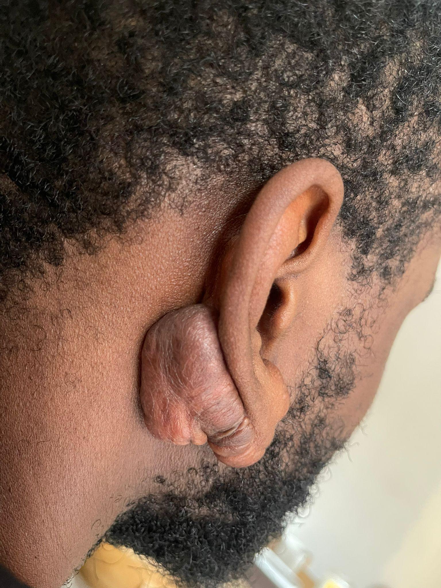 Ear Keloid