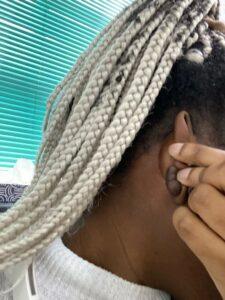 Earlobe keloid removal before and after Birmingham