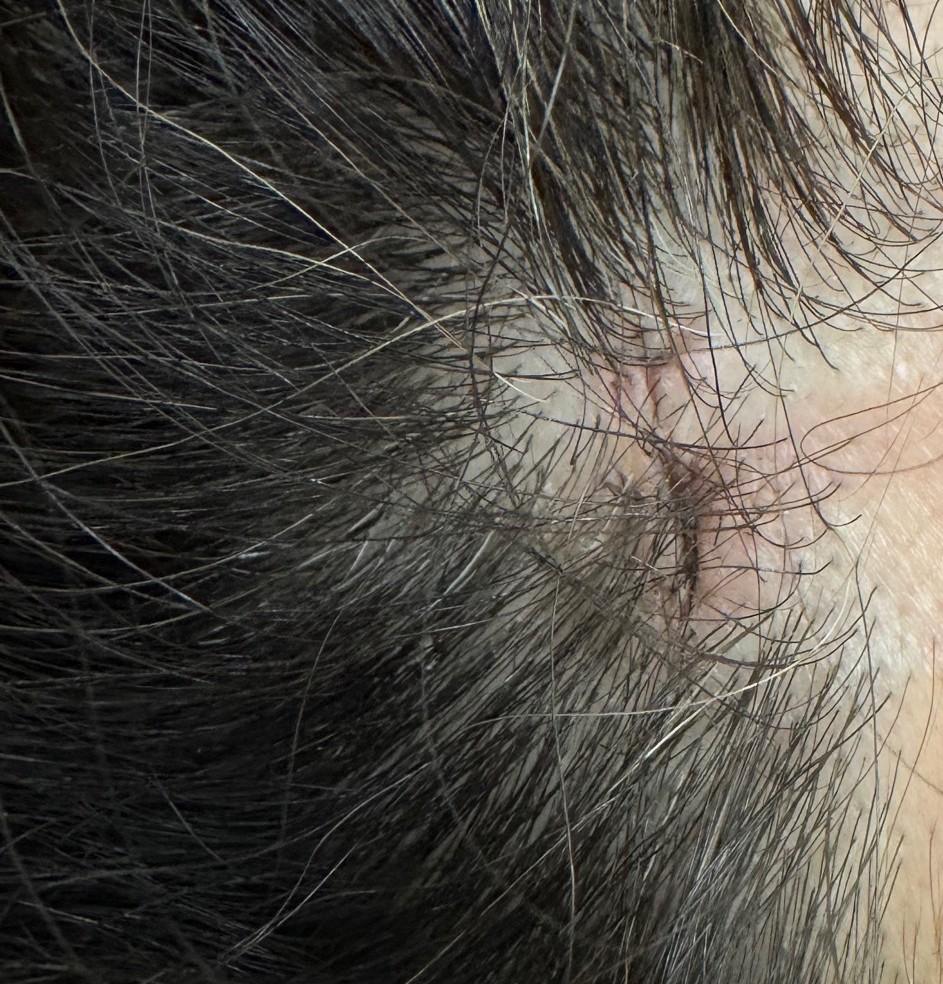 Hairline cyst site two weeks after removal