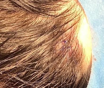 Hairline cyst immediately after removal