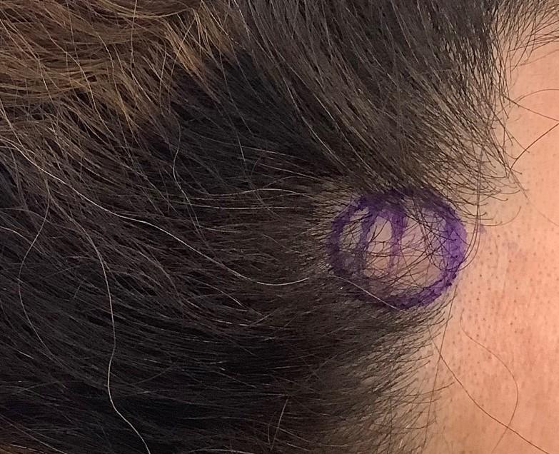 Cyst near the hairline marked before removal