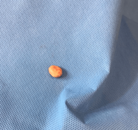 Cyst sac excised intact