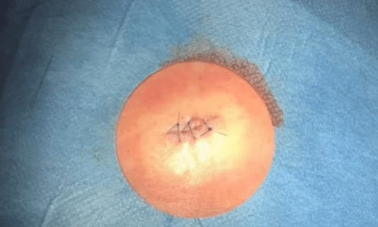 Forehead cyst immediately after removal