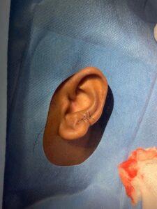 Earlobe keloid removal before and after Birmingham