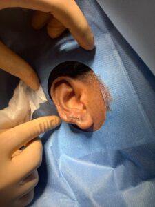 Earlobe keloid removal before and after Birmingham