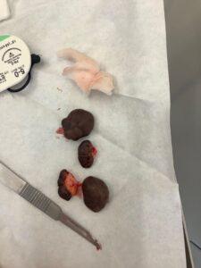 Earlobe keloid removal before and after Birmingham