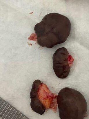 Earlobe keloid removal before and after Birmingham