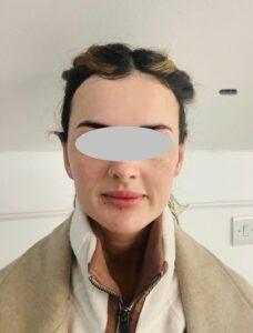 After Unilateral Right Pinnaplasty