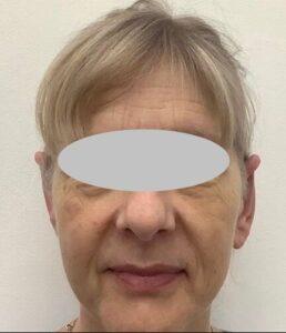 After Asymmetrical Left Pinnaplasty