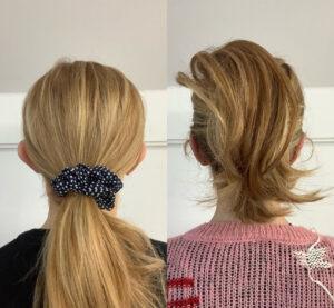 Back View Of Before And After Bilateral Pinnaplasty