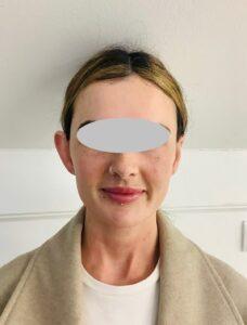 Before Unilateral Right Pinnaplasty