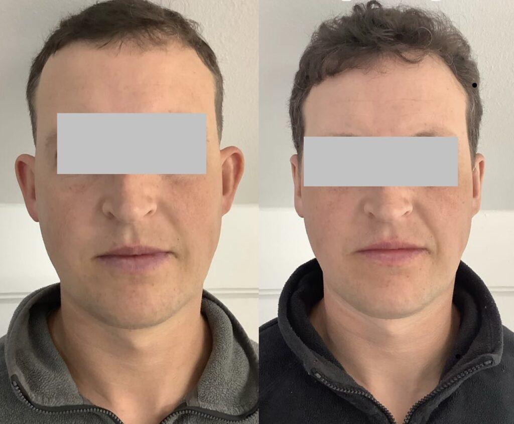 Before And After Pinnaplasty