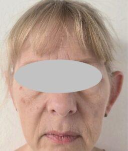 Before Asymmetrical Left Pinnaplasty