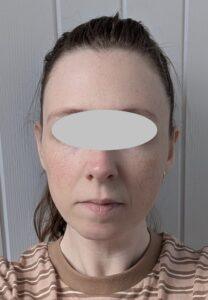 Girl After Pinnaplasty