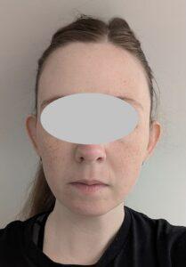 Girl Before Pinnaplasty