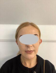 Lady Before Bilateral Pinnaplasty