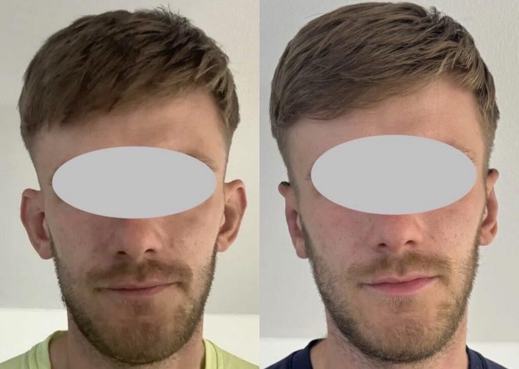 Before and After a bilateral pinnaplasty