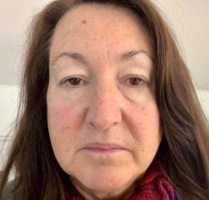 Before Upper eyelid Blepharoplasty
