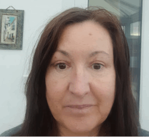 3-weeks after upper eyelid blepharoplasty