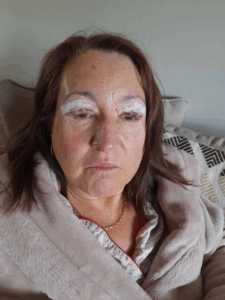 Day 1 post-op upper eyelid blepharoplasty