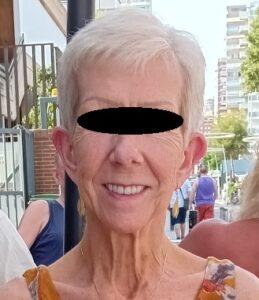 Woman Before Bilateral Pinnaplasty