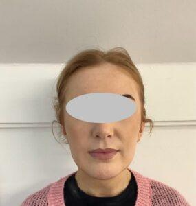 Lady After Bilateral Pinnaplasty