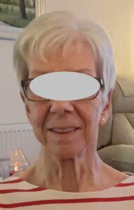 Woman After Bilateral Pinnaplasty