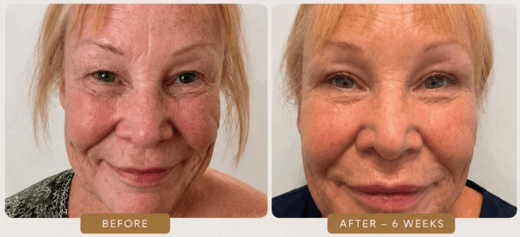 Before And 6 Weeks After Upper Eyelid Blepharoplasty Birmingham