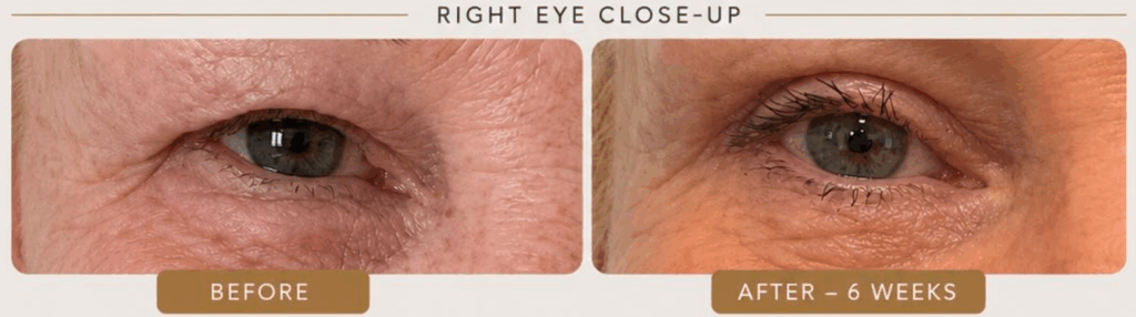 Right Eye Close Up Of Upper Eyelid Blepharoplasty Before And 6 Weeks After