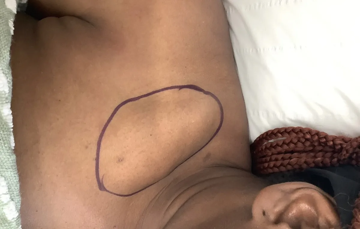 Large lipoma marked before removal