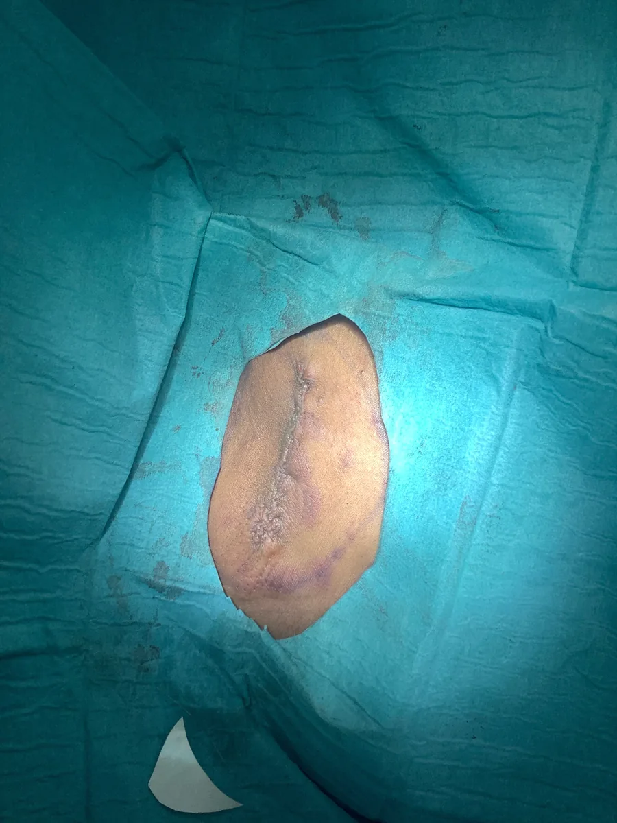 Sub-cuticular closure after large lipoma removal