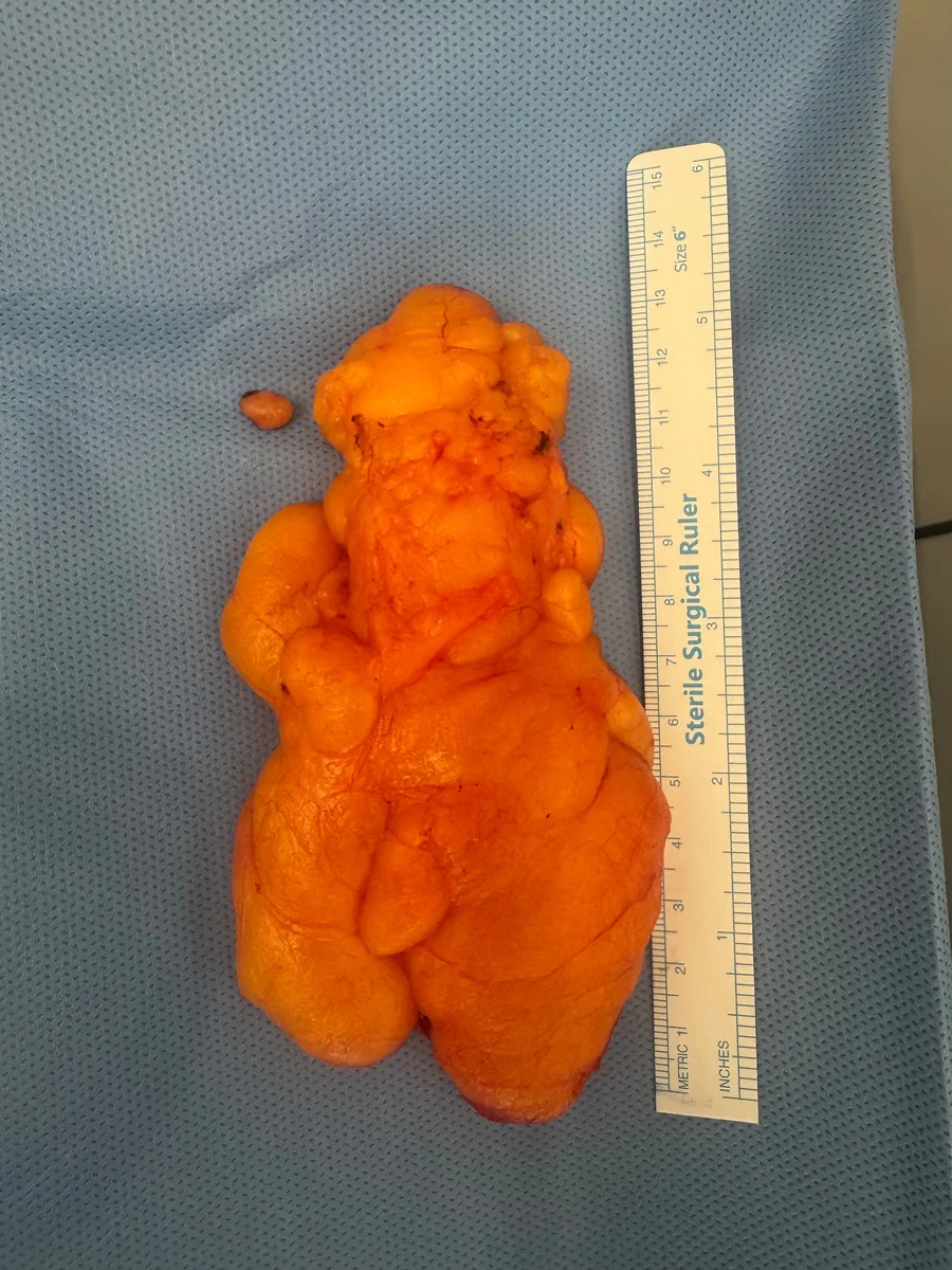 Large lipoma removed intact, shown next to a ruler