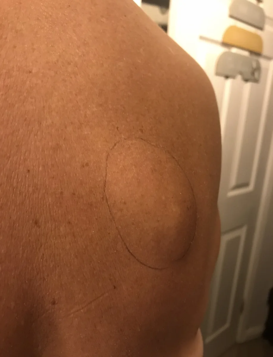 Lipoma on the back marked before excision